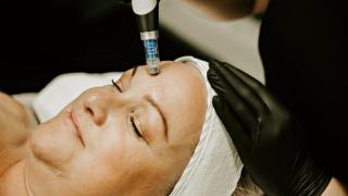 Dermapen Microneedling
